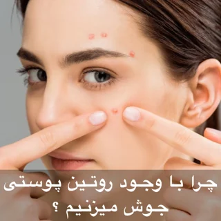 چرا با وجود روتین پوستی هنوز جوش میزنم؟ | ۷ دلیل پنهان که کسی نمیگوید